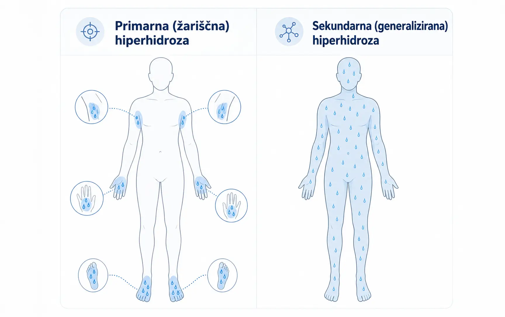 Infografika prikazuje razliko med primarno žariščno hiperhidrozo in sekundarno generalizirano hiperhidrozo.